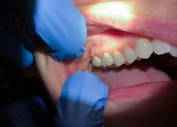 Best Emergency Wisdom Tooth Extraction in Headland, AL